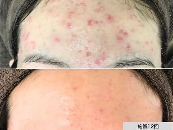 ニキビ研究所 千葉店/おでこニキビでお悩みの方へ！