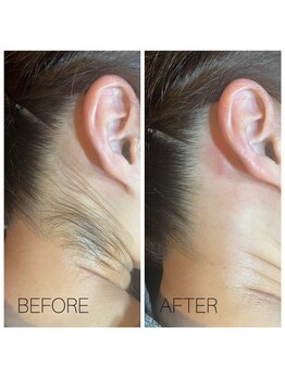 ココリ(CoCoRe)/うなじMIX脱毛