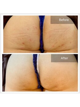 エミルカ(EMILUCA)/ハーブピーリングでお悩み改善