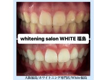 ホワイトニングサロン ホワイト(WHITE)/セルフホワイトニング/大阪/福島
