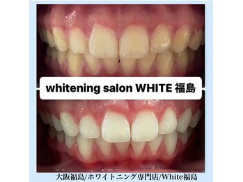 ホワイトニングサロン ホワイト(WHITE)/セルフホワイトニング/大阪/福島