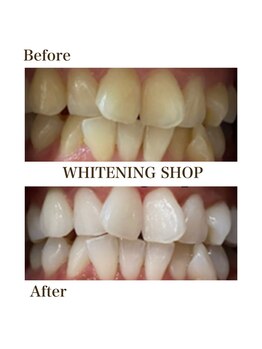 ホワイトニングショップ 銀座7丁目店(WHITENING SHOP)/Before After