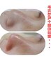 【新規】毛穴洗浄+美容導入ハイドラフェイシャル¥7700→¥4500