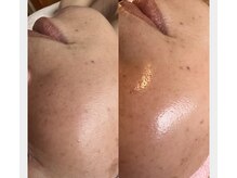 ラヴィエール(Laviere)/スキンケアフェイシャルワックス