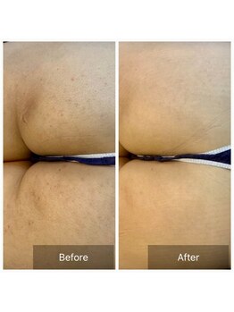 エミルカ(EMILUCA)/ハーブピーリングでお悩み改善