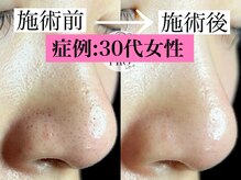 ラボキュー(LABO-9)/毛穴エクストラクションプロ