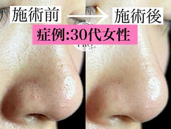 ラボキュー(LABO-9)/毛穴エクストラクションプロ