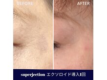 水光ピールスキンの雰囲気（スーパージェクションエクソソーム導入1週間後の変化）