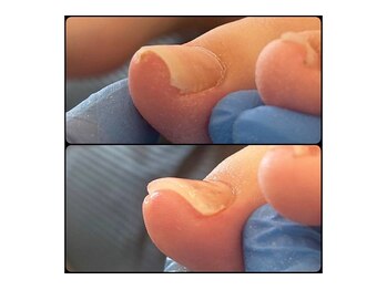 ゲンキー(genkey)/巻き爪改善お任せください♪