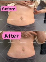 ナラビューティー(NARA BEAUTY)/韓国最新オンタリフト導入！