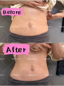 ナラビューティー(NARA BEAUTY)/韓国最新オンタリフト導入!