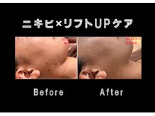 エステティック レイビス 銀座店(RAYVIS)/ホワイトスノーピール×ハーブ