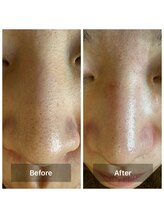 フェイシャルサロン ミギー(Miggie)/施術１回で変わる！直後の変化