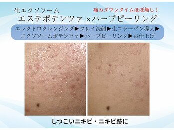 エイミー(Aimee)/お肌に負担なくケア！