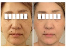 イーオ(io)/グロウピール継続のお客様