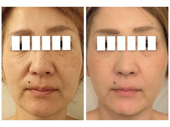 イーオ(io)/グロウピール継続のお客様