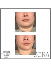 ソラ 天神 大名(SORA)/切らないリフト60kj1回