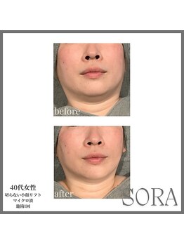 ソラ 天神 大名(SORA)/切らないリフト60kj1回