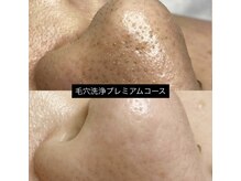 ソアン(Soin)/毛穴洗浄プレミアム