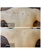 エミルカ(EMILUCA)/ハーブピーリングでお悩み改善