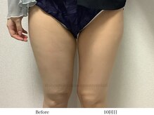 スラリ(SLARI)/【太もも　脂肪冷却】