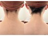 もう悩まない【えりあし+うなじ脱毛】お悩みに合わせたデザイン技術が人気◎