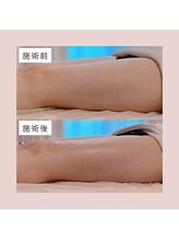 ミーティス/脚が軽くなった！とのお声も♪