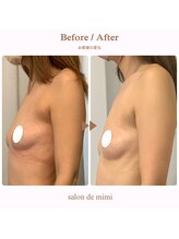 サロン ド ミミ(salon de mimi)/バストアップBeforeAfter