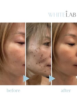 エルフ(elf)の写真/速効実感！話題の”ペリッ”とシミ改善【最新シミケア♪ホワイトラボ★無料相談￥0】驚きの結果に感動♪