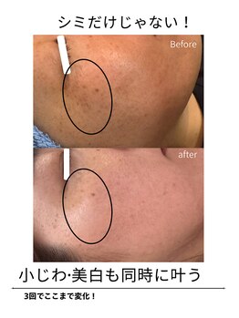 エイチケービューティーサロン(H/K beauty salon)/【小ジワも改善】