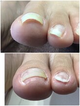 モアクリスタル(More Crystal)/巻き爪補正