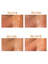 ベッラドンナ(Bella donna)/シミの改善BeforeAfter