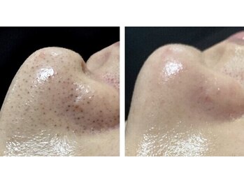 サロン リーナ 北千住店(Salon Lena)/毛穴の黒ずみ角栓徹底除去