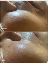 スパークル/ワックス/毛穴洗浄/脱毛/小顔