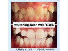 ホワイトニングサロン ホワイト(WHITE)/セルフホワイトニング/大阪/福島