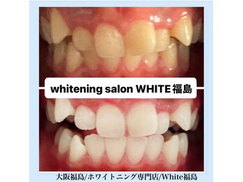 ホワイトニングサロン ホワイト(WHITE)/セルフホワイトニング/大阪/福島