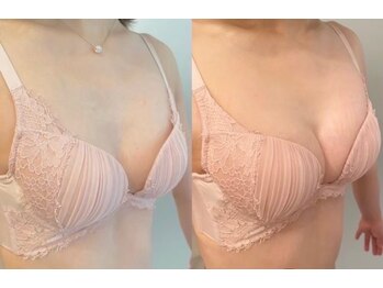 美人バスト 札幌店/バストアップ×育乳 &nbsp;◇症例◇