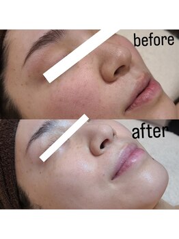 シス(SiS.)/ハーブピーリング×エレクトロポ