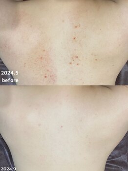 フルール(Fleur)/■背中トリートメント■