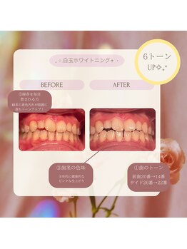 プラスビーセルフ(+b self)/ホワイトニングビフォーアフター