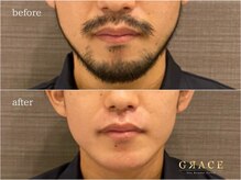 グレイス 久留米店(GRACE)/ヒゲWAX +光脱毛