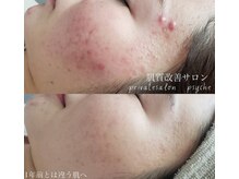プシュケ(Psyche)/お客様の肌変化