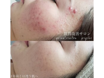 プシュケ(Psyche)/お客様の肌変化
