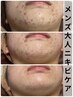 【メンズ必見!】結果重視★ニキビケア・肌荒れから卒業!オーダーメイド90分
