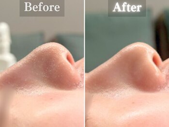 ボーンオム(Born Homme)/毛穴洗浄＋美容液導入：20代女性