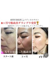 デアマリス/元シミ肌サーファーオーナーの私