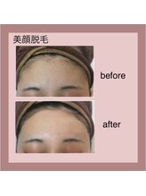 エステティック レイビス 秋田店(RAYVIS)/トーンアップも出来る美顔脱毛☆