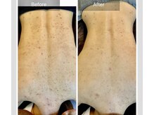 エミルカ(EMILUCA)/ハーブピーリングでお悩み改善