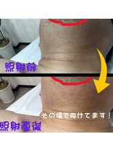 フェリッセ(FELISSE)/あご裏　照射前と照射直後の違い