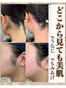 ギューテ(Gute)/うなじ脱毛